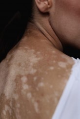 renata_plaszowska Projekt:
https://www.instagram.com/vitiligo_people/
Foto: Justyna Dudziak