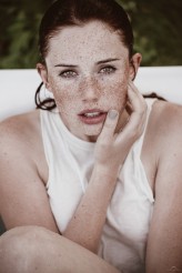 freckles_