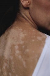 renata_plaszowska Projekt:
https://www.instagram.com/vitiligo_people/
Foto: Justyna Dudziak